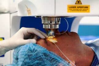 Laser vision surgery