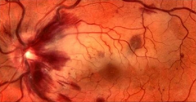 retinal vessels and restoration of vision